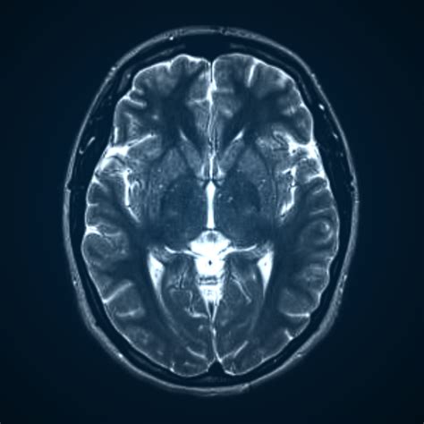 the villages brain ct scan|MRI SCANS .